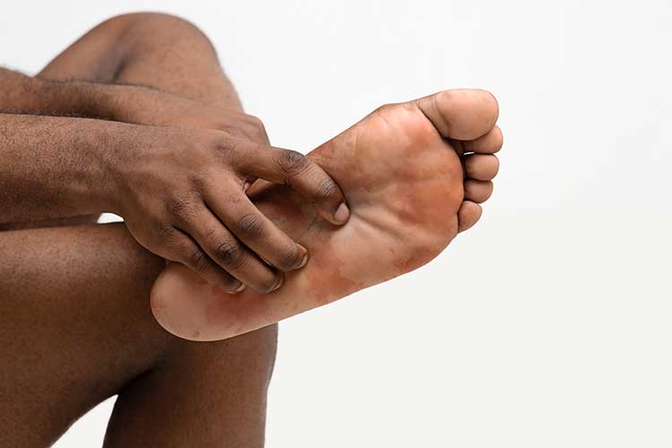 Image of a Black man's legs. He has one leg rested over the other and is scratching his feet because of hives.