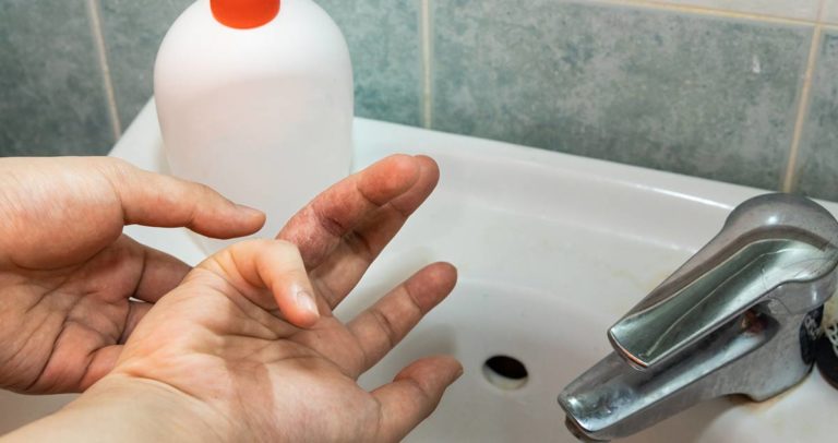 Hombre lavándose las manos con eczema en los dedos
