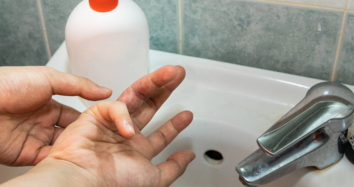 Hombre lavándose las manos con eczema en los dedos