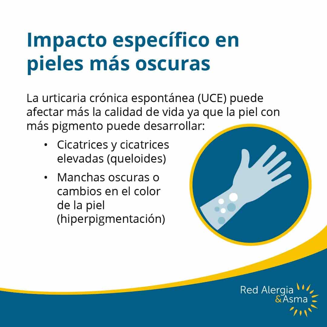 Infografía sobre el impacto de la urticaria crónica espontánea en pieles oscuras, mostrando un brazo con ronchas y texto que menciona cicatrices, queloides y manchas por hiperpigmentación.